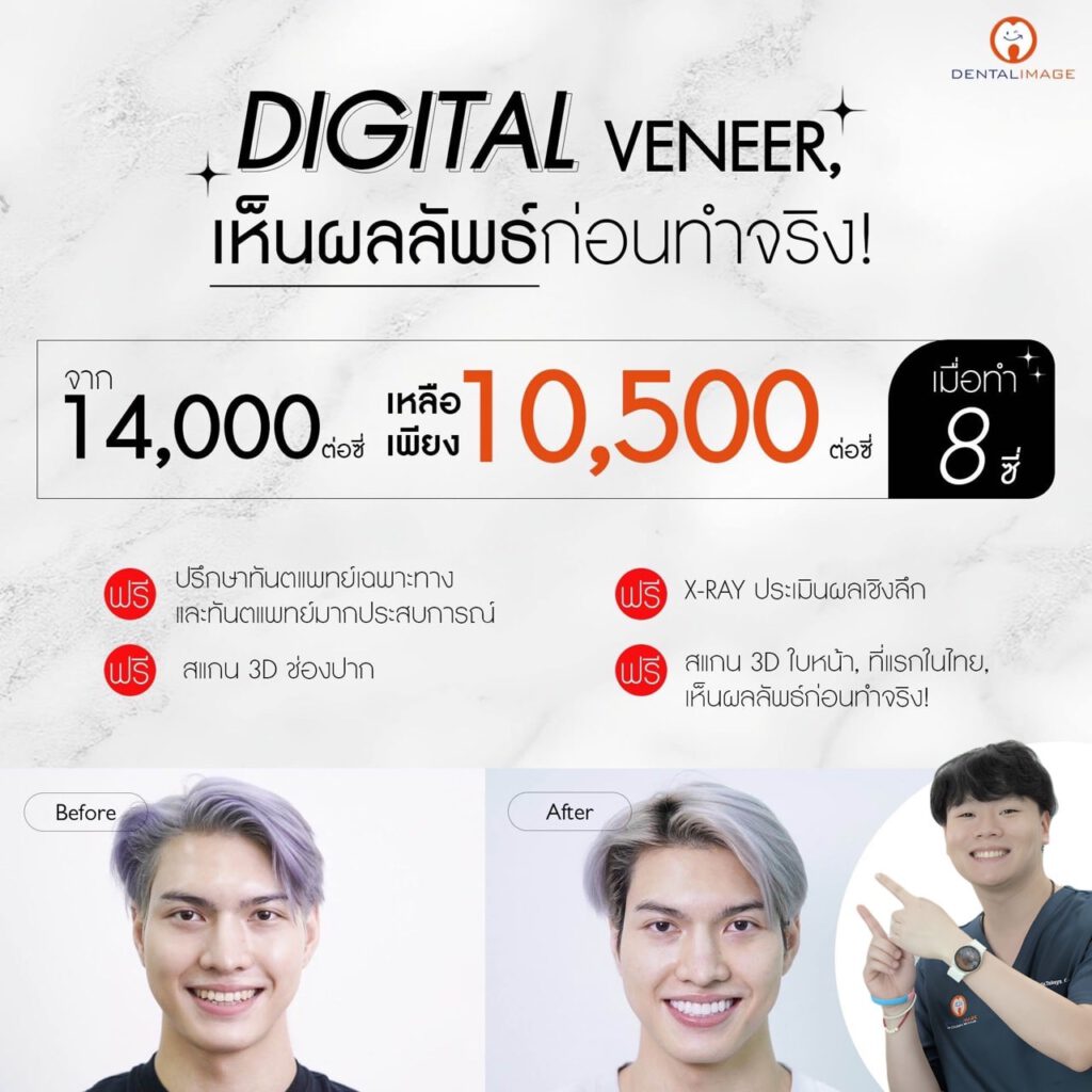 โปรโมชั่น Digital Veneer