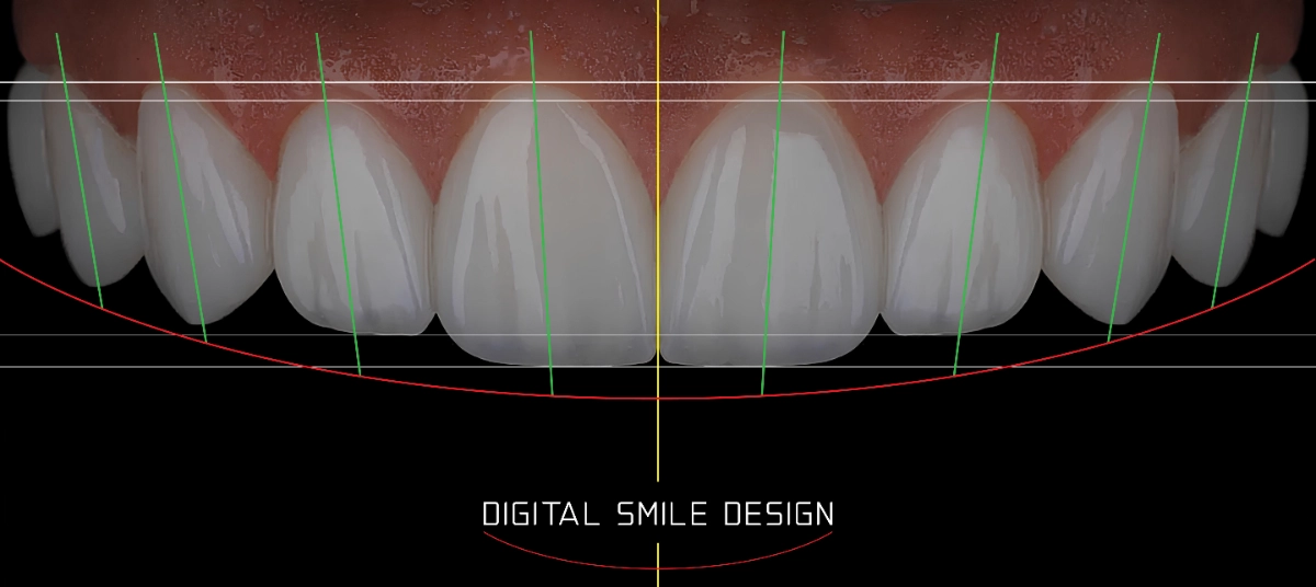 ปรึกษาทำวีเนียร์ฟรี! ขั้นตอนการออกแบบรอยยิ้มด้วยระบบ Digital Smile Design