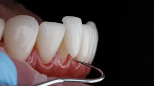 ทำวีเนียร์ 1 ซี่ ราคาเท่าไหร่? อัปเดตราคาล่าสุดปี 2026 (รวมวัสดุทุกแบบ)