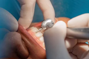 ก่อนทำวีเนียร์ต้อง "เคลียร์ช่องปาก" อะไรบ้าง? สรุปค่าใช้จ่ายแฝงที่คุณต้องรู้