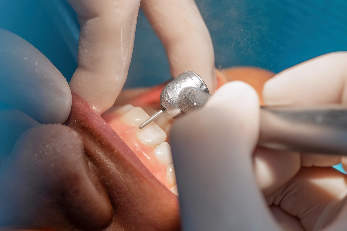 ก่อนทำวีเนียร์ต้อง "เคลียร์ช่องปาก" อะไรบ้าง? สรุปค่าใช้จ่ายแฝงที่คุณต้องรู้